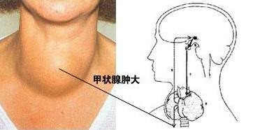 甲状腺肿大怎么治疗？