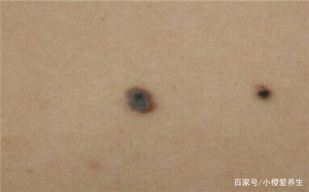 你知道黑色素瘤它的主要症状是什么吗？