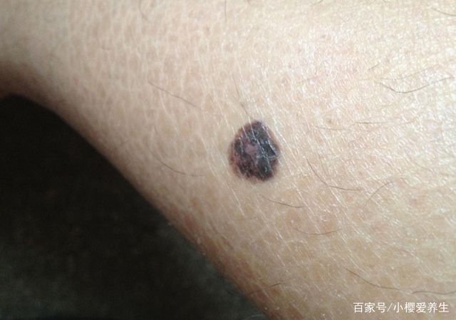 你知道黑色素瘤它的主要症状是什么吗？