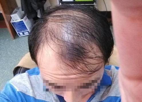 斑秃治疗最快的方法？？
