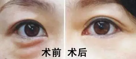 怎么样去眼袋效果好