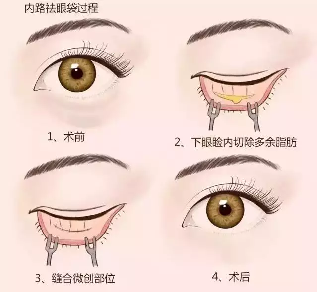 怎么样去眼袋效果好
